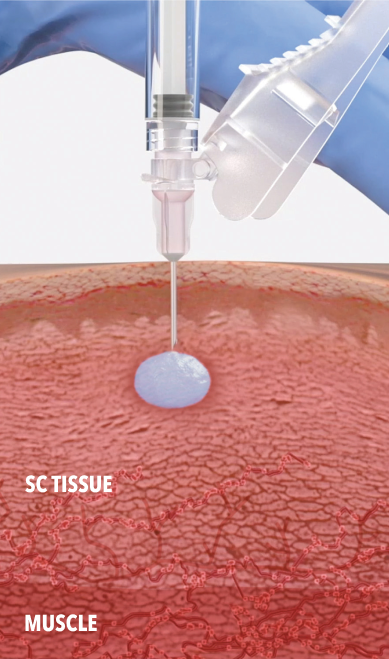 Image of the syringe detailing the polymeric gel being injected